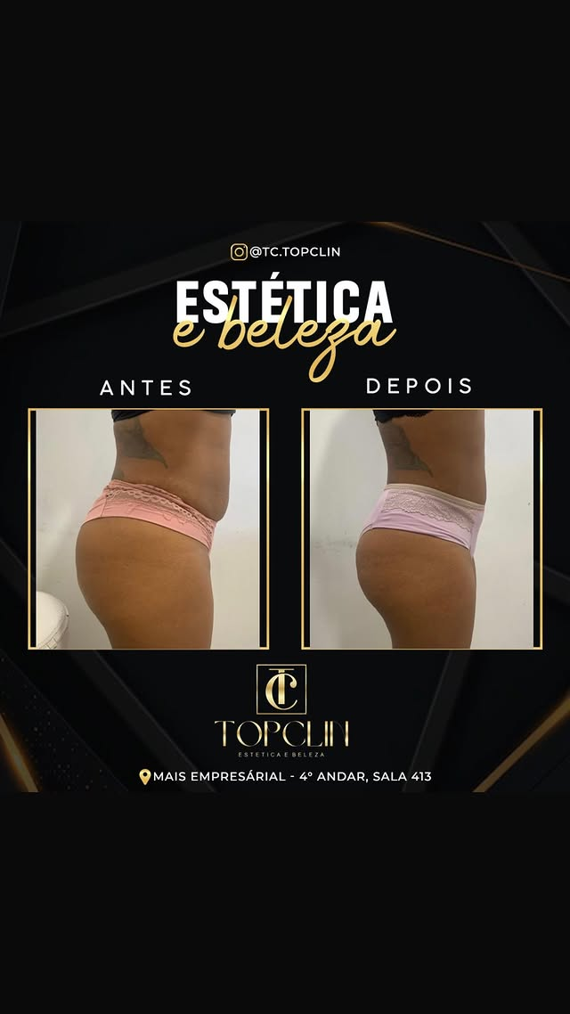 Antes e depois de tratamento corporal em glúteos e laterais