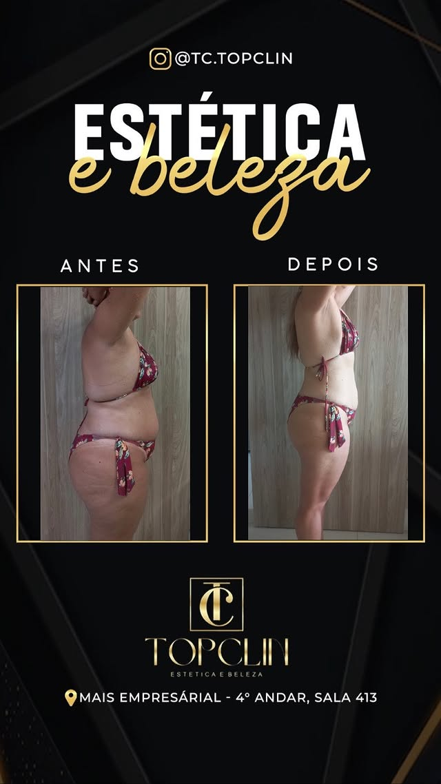 Antes e depois de emagrecimento com redução de medidas, vista lateral