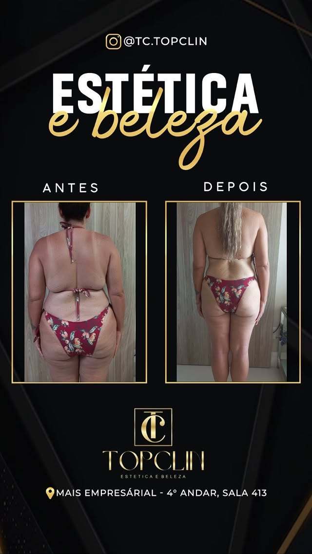 Antes e depois de emagrecimento com redução de medidas, vista de costas