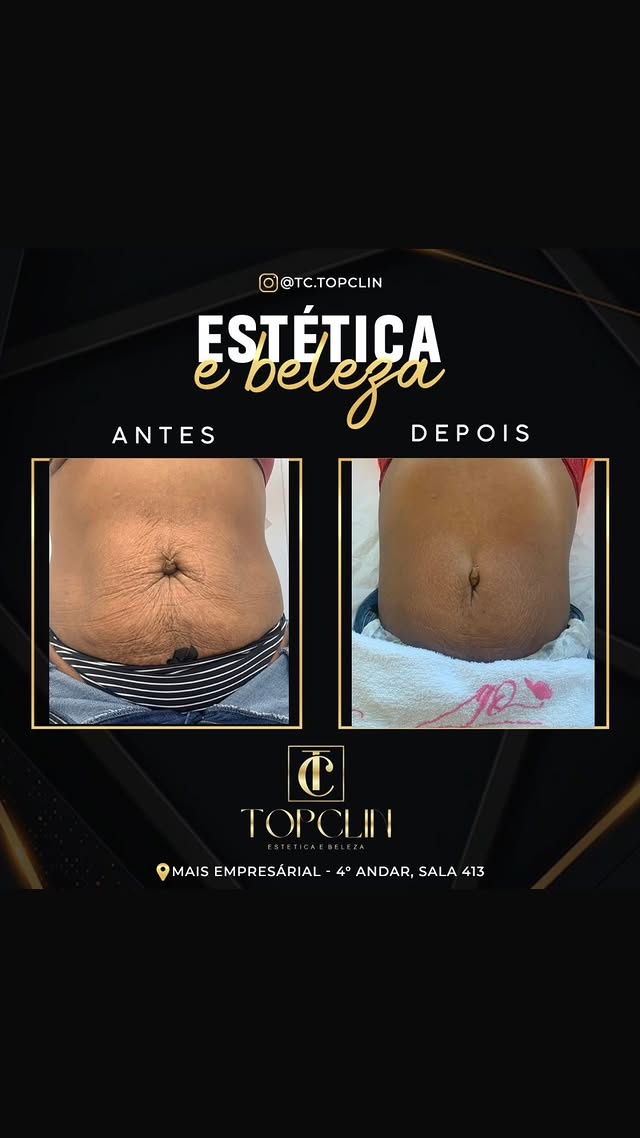 Antes e depois de tratamento para firmeza da pele do abdômen