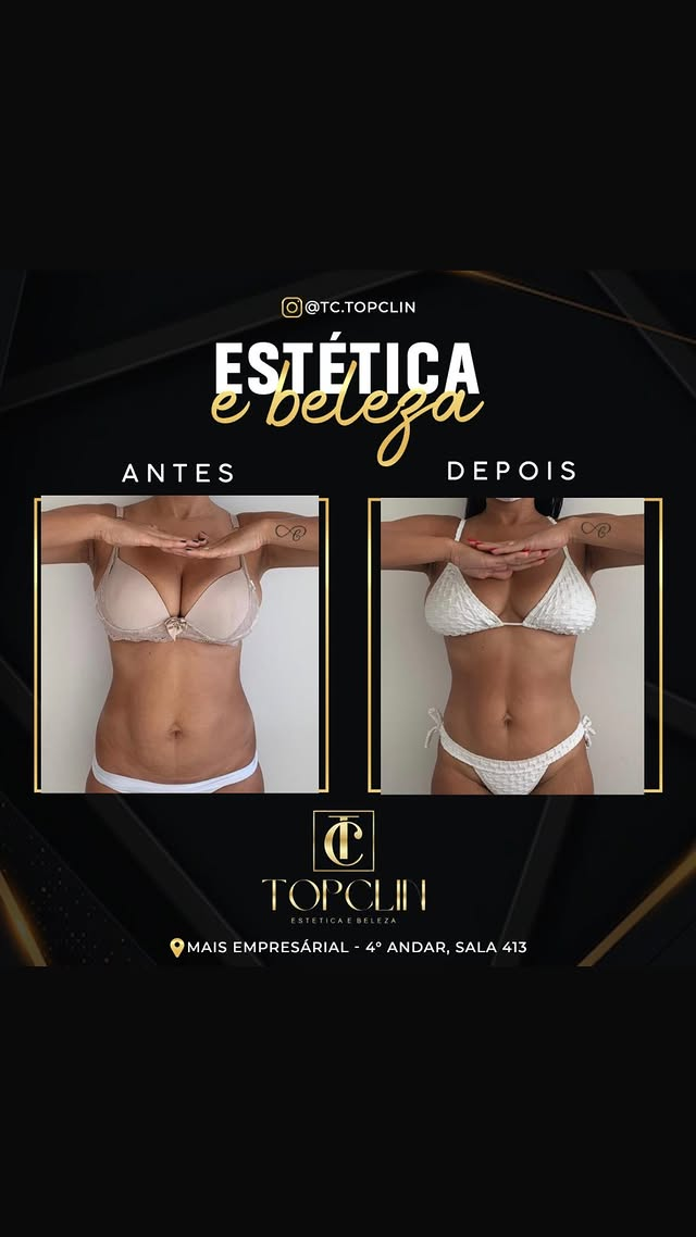 Antes e depois de tratamento corporal na região do abdômen